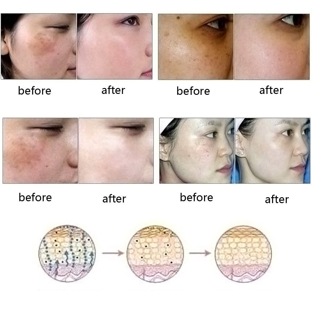 Acne Stretch Marks Scar Removal oil