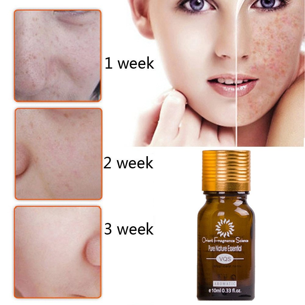 Acne Stretch Marks Scar Removal oil